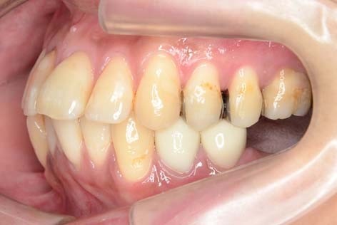 第一・第二大臼歯を抜歯欠損した患者様の歯列矯正治療について