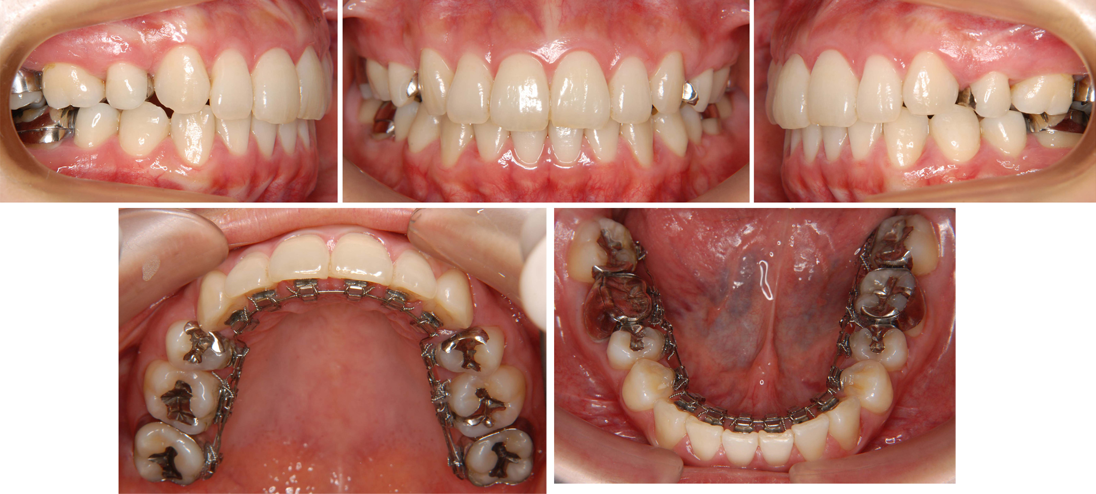 上顎前突 出っ歯 の診断と種類そして治療例とリスク ドクターズブログ 舌側矯正のアイ矯正歯科クリニック