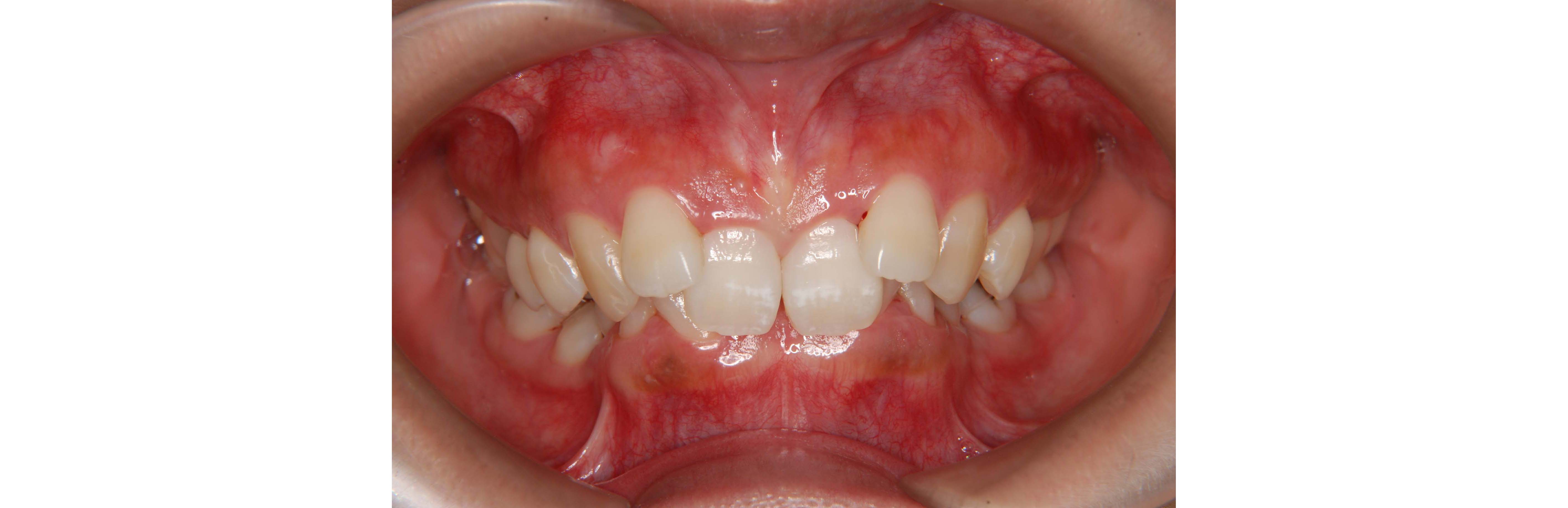 上顎前突 出っ歯 の診断と種類そして治療例とリスク ドクターズブログ 舌側矯正のアイ矯正歯科クリニック