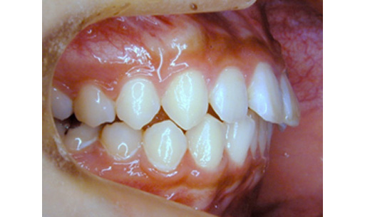機能性不正咬合とはどんな状態か 成り立ちや診断 治療方法について ドクターズブログ 舌側矯正のアイ矯正歯科クリニック