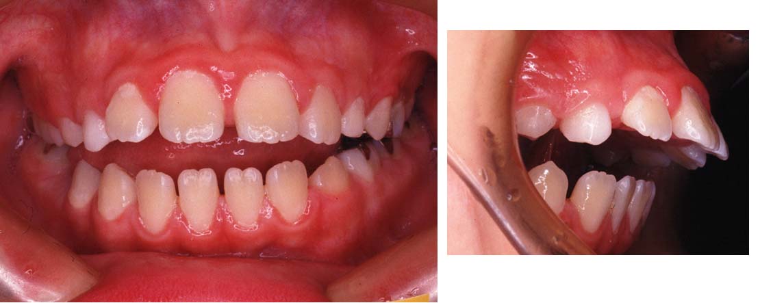 機能性不正咬合とはどんな状態か 成り立ちや診断 治療方法について ドクターズブログ 舌側矯正のアイ矯正歯科クリニック