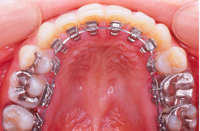 見えない矯正治療-リンガルブラケットとは。特徴や治療例を紹介します