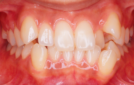 八重歯 叢生 乱杭 の原因やリスク 治療法 ドクターズブログ 舌側矯正のアイ矯正歯科クリニック