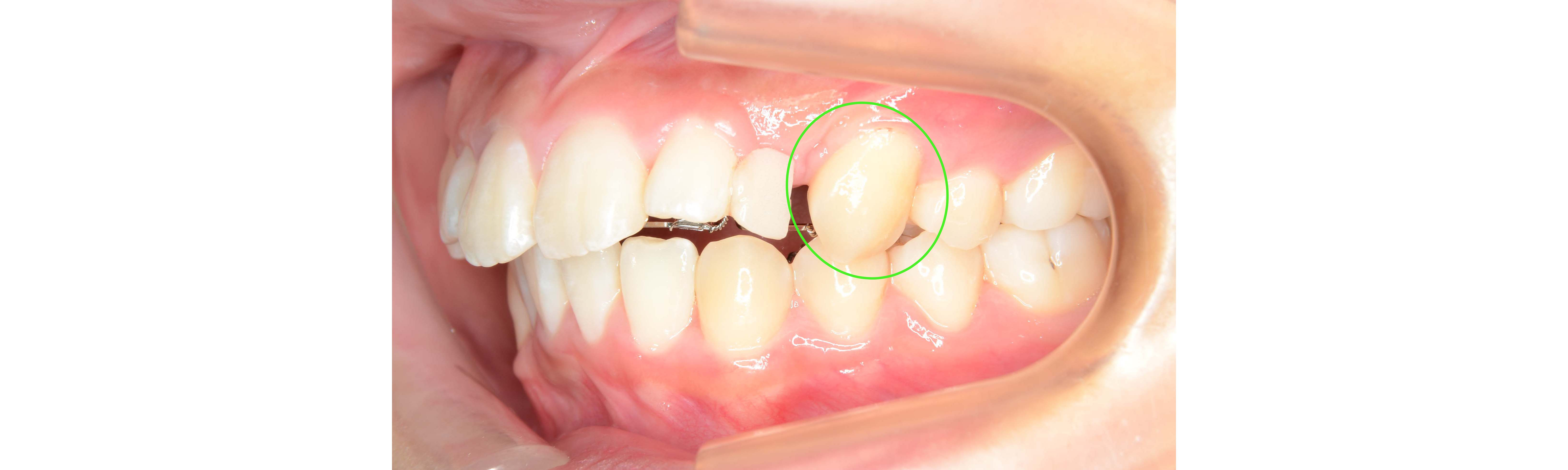 歯の萌出位置異常、埋伏歯、過剰歯の治療