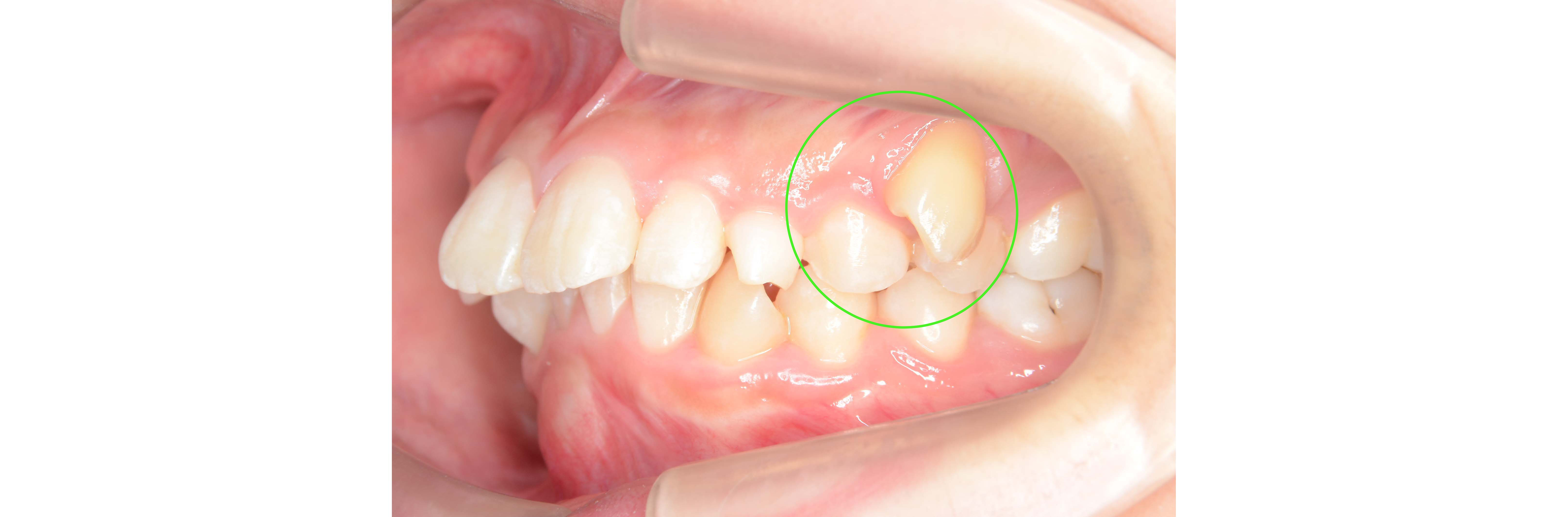 歯の萌出位置異常 埋伏歯 過剰歯の治療 ドクターズブログ 舌側矯正のアイ矯正歯科クリニック