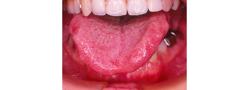 開咬 かいこう オープンバイト の症状や原因 リスクと治療法 ドクターズブログ 舌側矯正のアイ矯正歯科クリニック