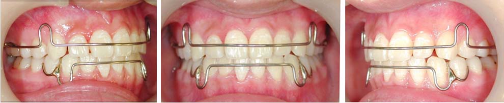 矯正歯科における保定期間と保定装置 リテーナー の種類について ドクターズブログ 舌側矯正のアイ矯正歯科クリニック