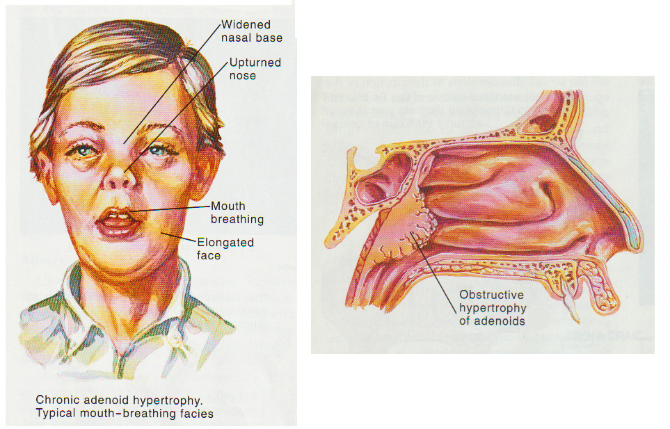 除去のリスクと合併症
